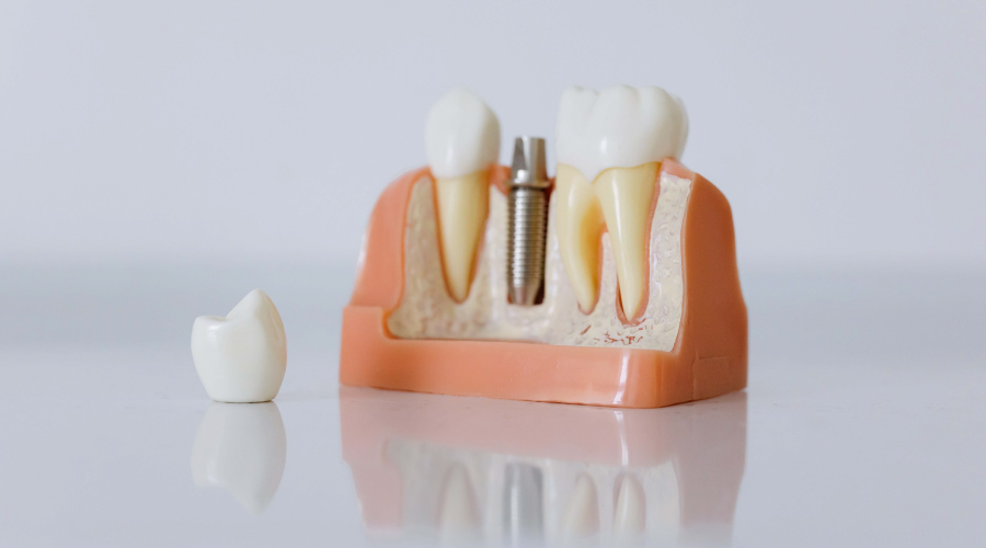 Los implantes dentales con carga inmediata