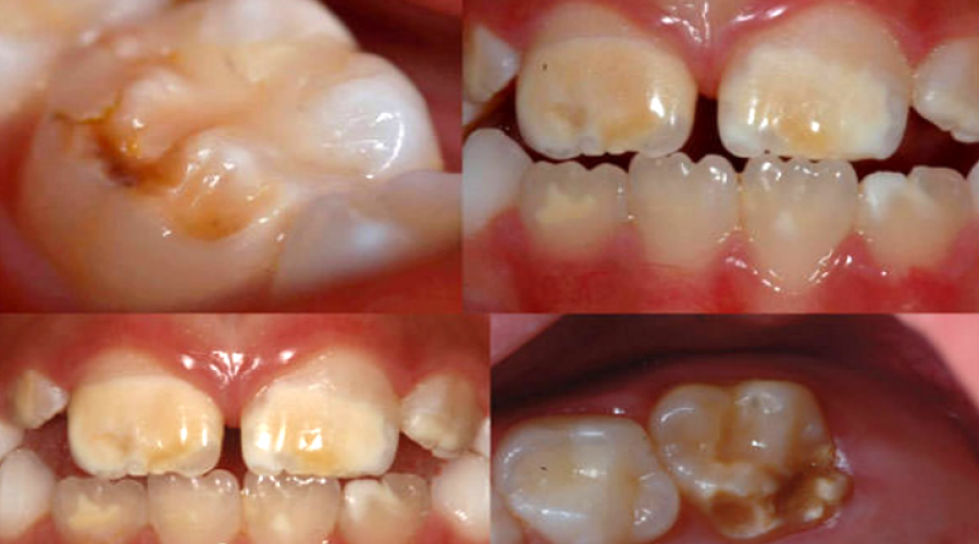 Manchas en los dientes: La hipoplasia dental en niños