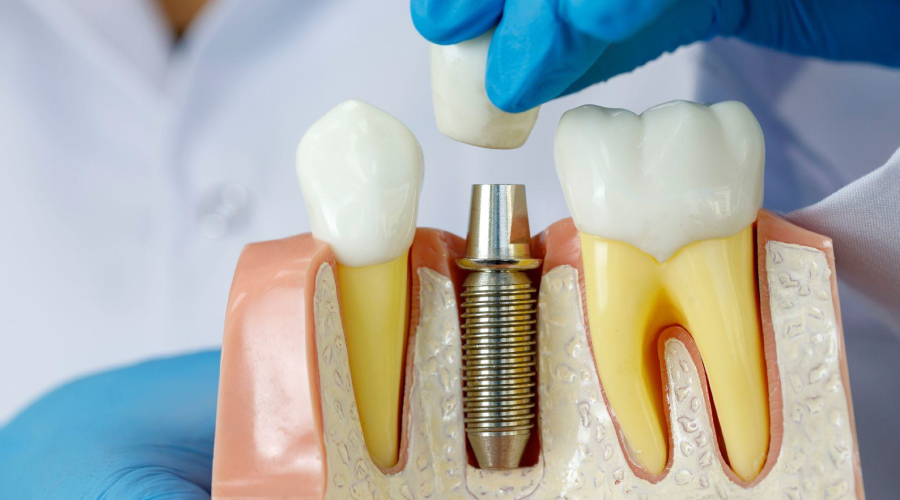 Los implantes dentales: La mejor opción para recuperar su sonrisa
