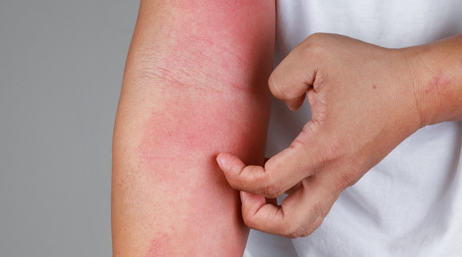 Cómo se manifiesta la dermatitis atópica