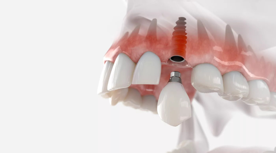 No posponga la colocación de implantes dentales