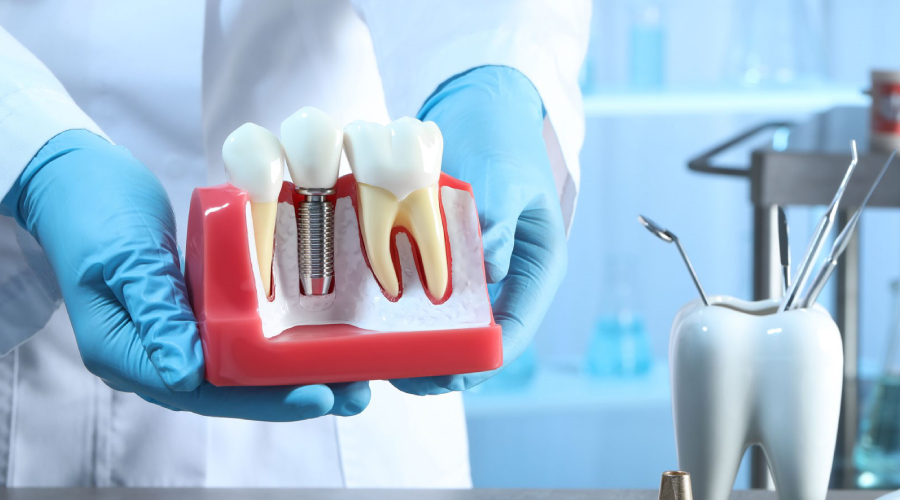 ¿Por qué los implantes dentales son la primera opción de rehabilitación dental?