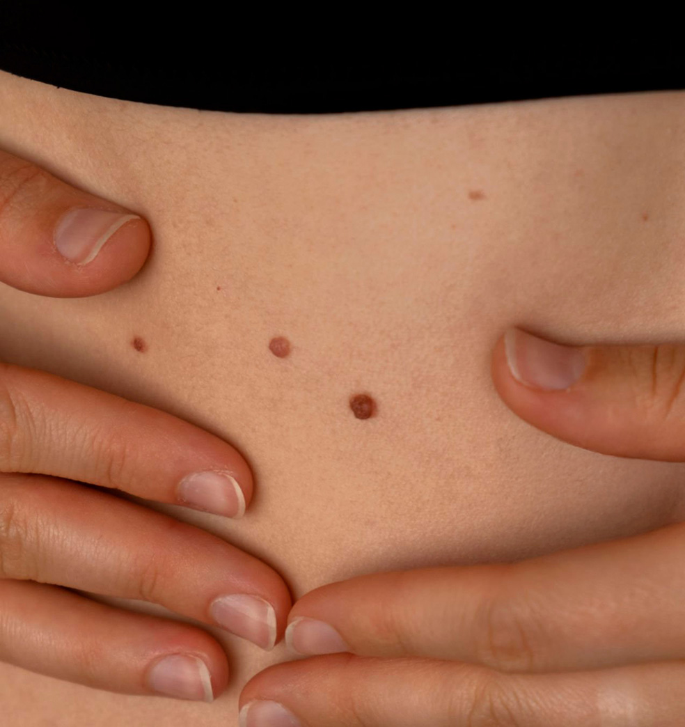 5 Consejos para controlar los lunares de forma práctica  