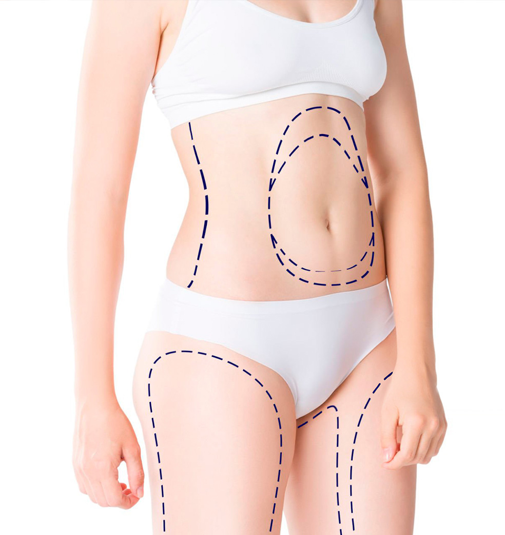 Como mejorar su silueta tras perder mucho peso