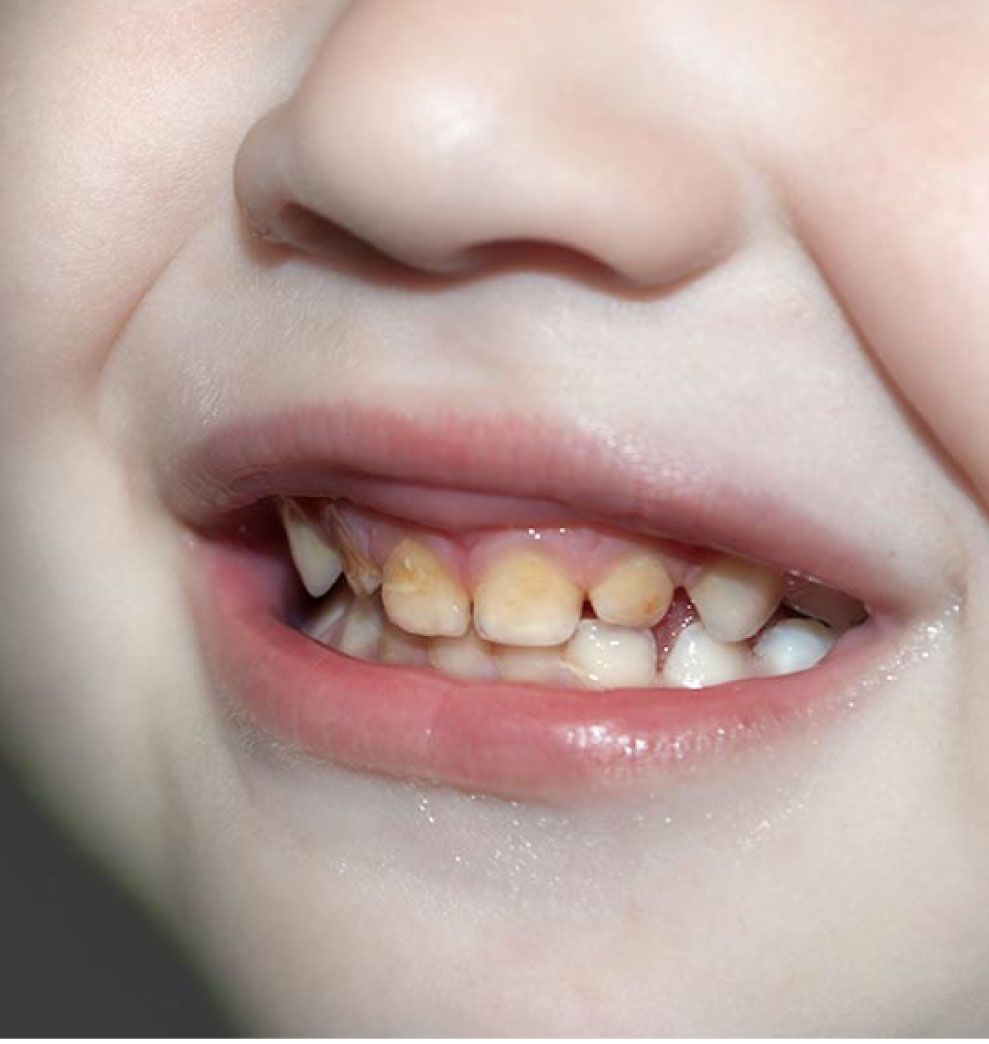 Causas y tratamiento de las manchas en dientes temporarios