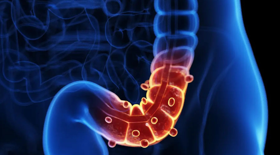 Diverticulitis aguda: Diagnóstico y tratamiento