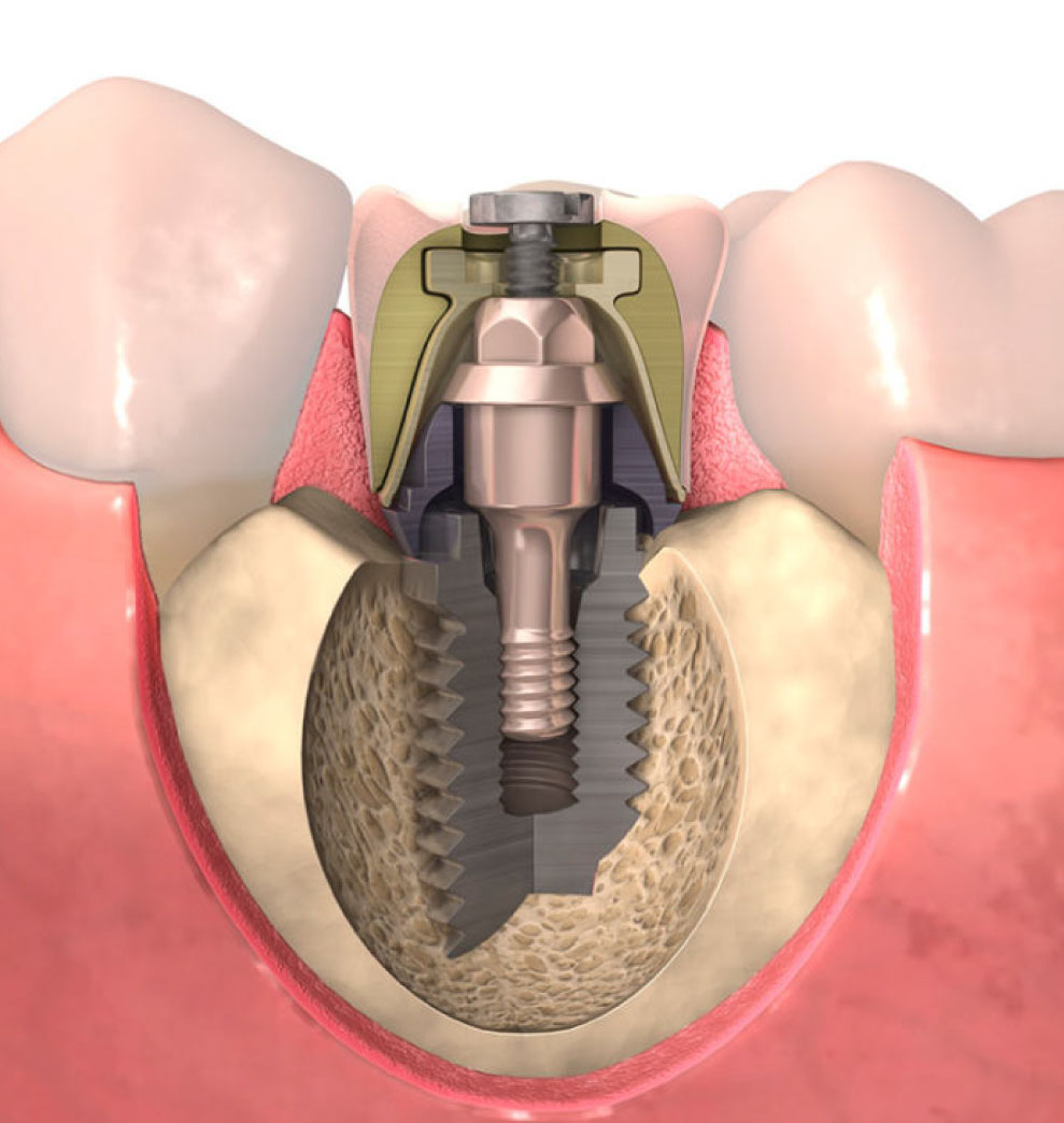 Endodoncia vs. Implantes dentales?