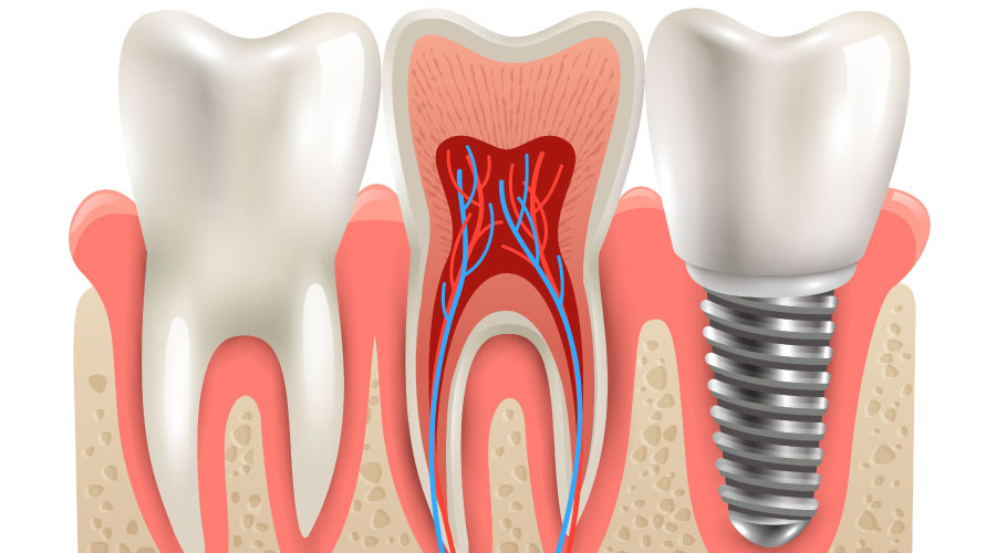 Por qué no es conveniente posponer la colocación de implantes dentales