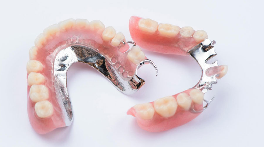 ¿Implantes o prótesis dentales?