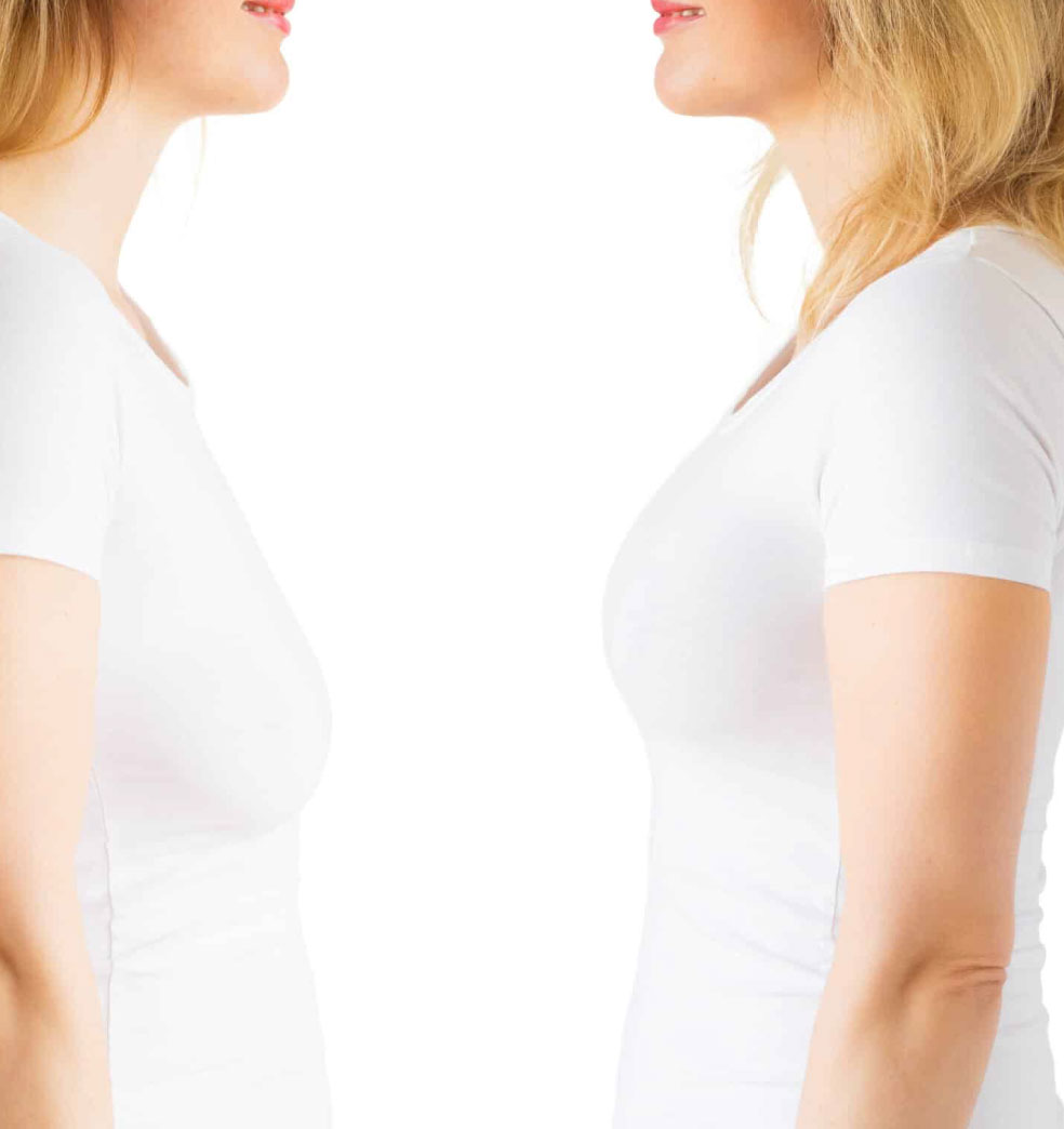 Pre y Posoperatorio del procedimiento de levantamiento mamario?