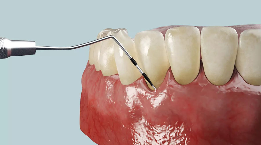 Posibles complicaciones de los implantes dentales: ¿por qué ocurren?