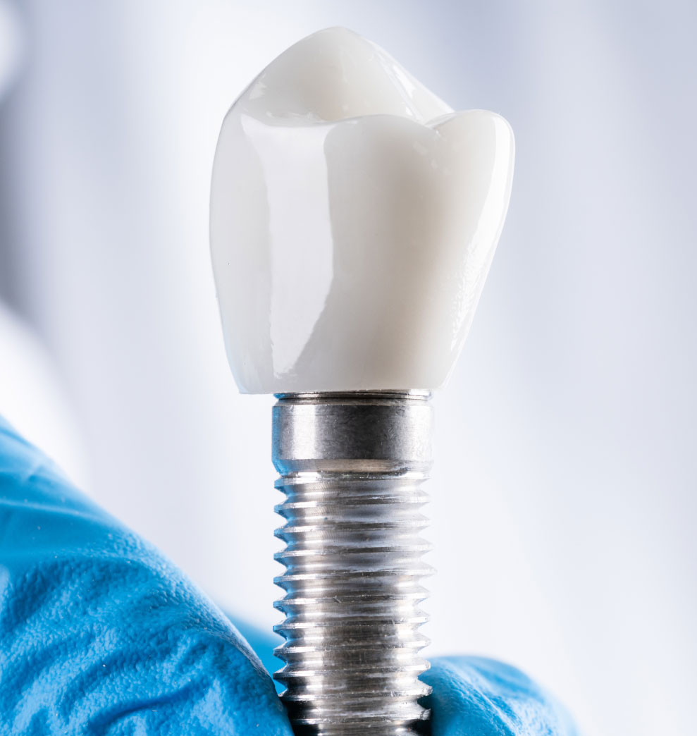 Respuestas a las dudas frecuentes sobre implantes dentales?