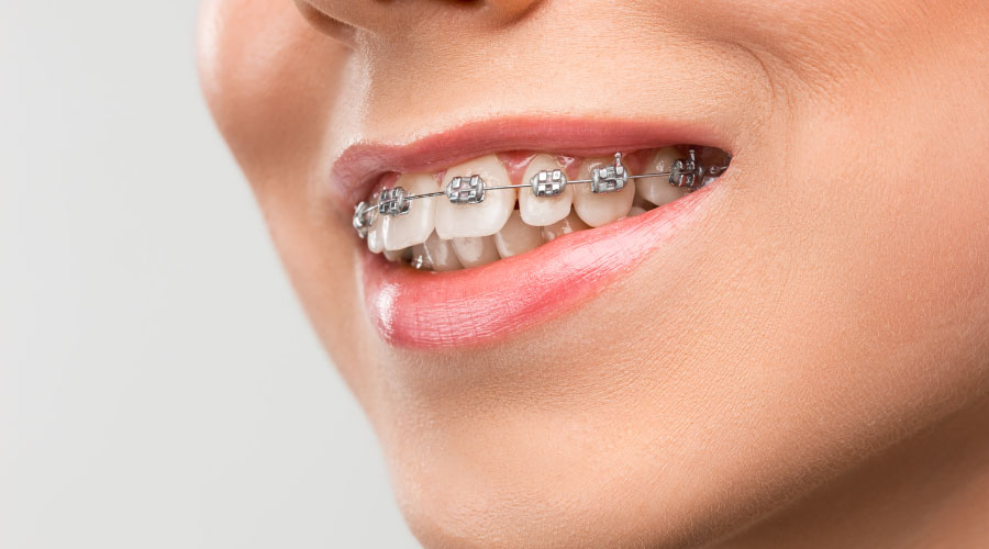 Tipos de brackets y su utilización en ortodoncia