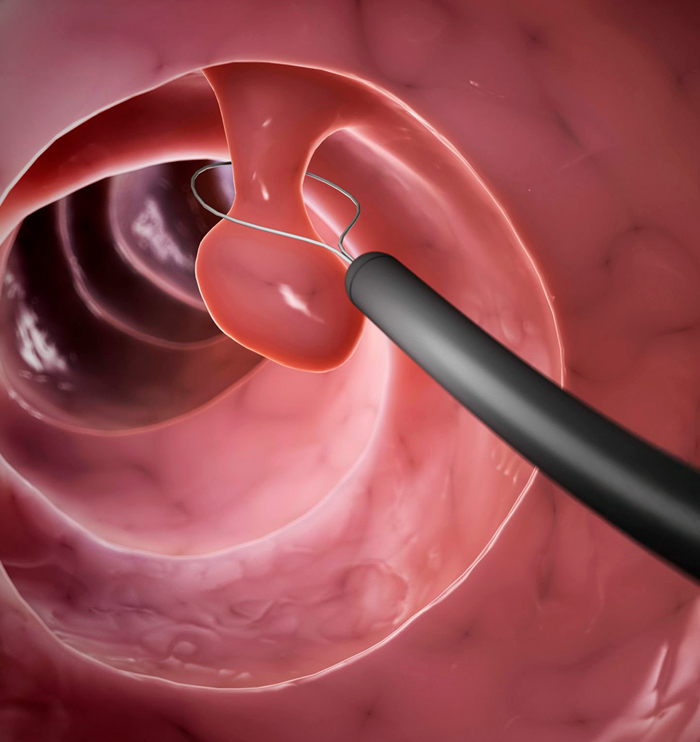 Todo sobre: Cáncer de colon  