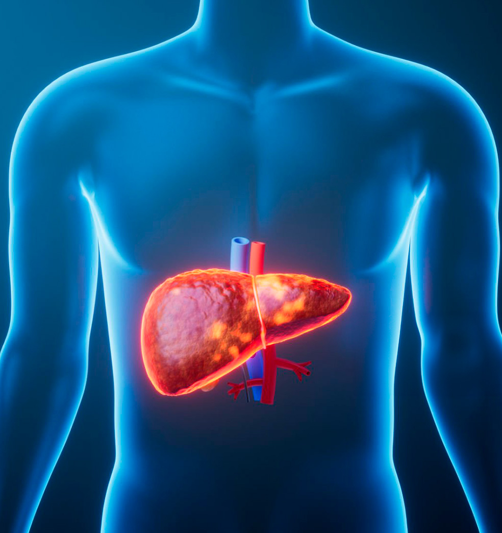 Todo sobre la cirrosis