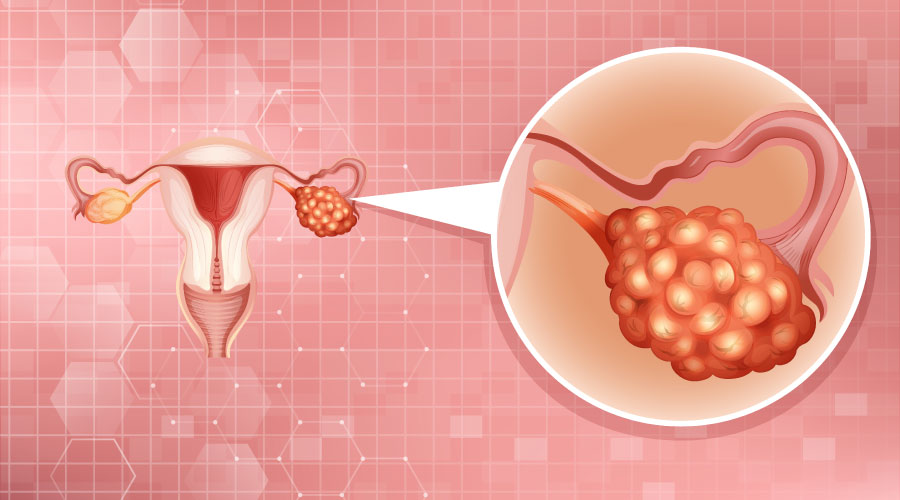 Características y tratamiento del síndrome de ovario poliquístico